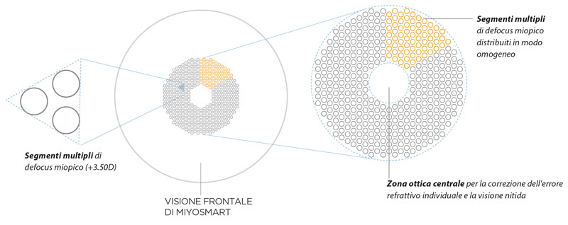 MiyoSmart trattamento lenti per la miopia